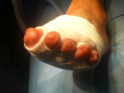 Vendatge post operatori